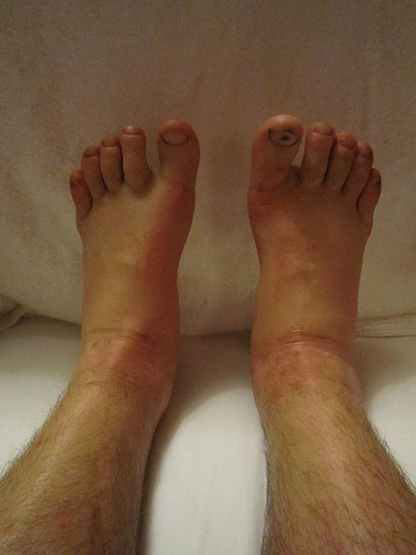 Edema, mais conhecido como inchaço, é um dos sintomas que geram a dor. Foto (CC BY-SA 3.0/  Licença Creative Commons)