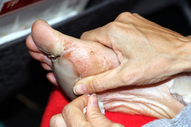 Ela está aplicando o produto Compeed que foi indicado por outros atletas para o tratamento das bolhas Foto: arquivo pessoal