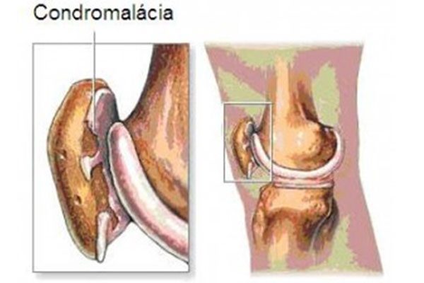 O desenho mostra a fragmentação focal da cartilagem articular da patela (foto: Arquivo pessoal)